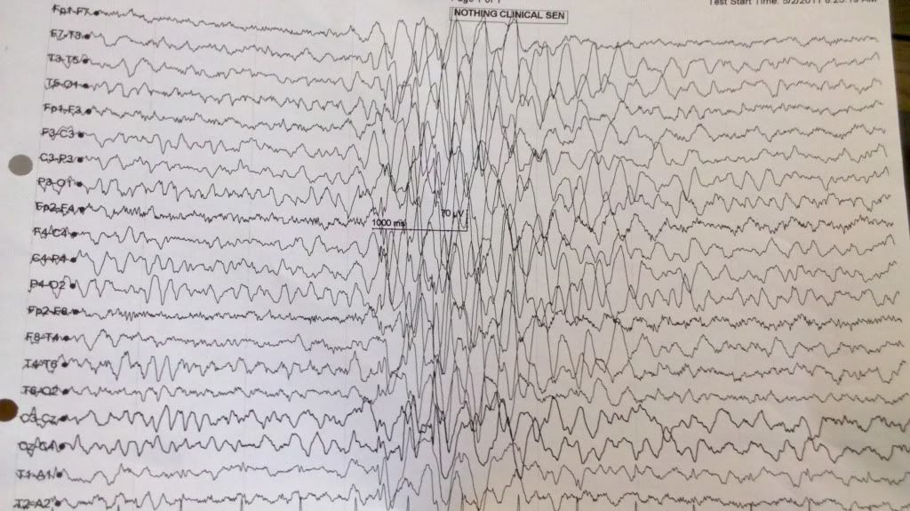 What Does An Abnormal Eeg Mean