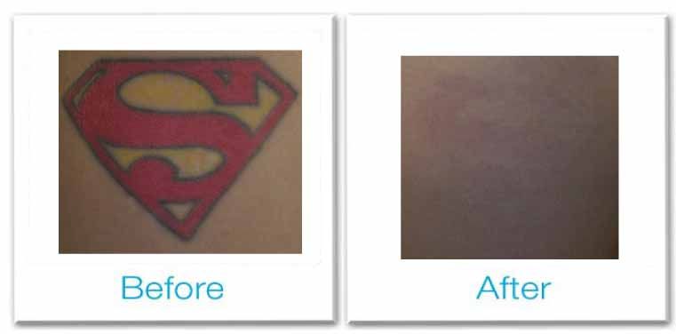 Vancouver Laser Tattoo Removal | Richmond BC Tattoo Removal | Reviva